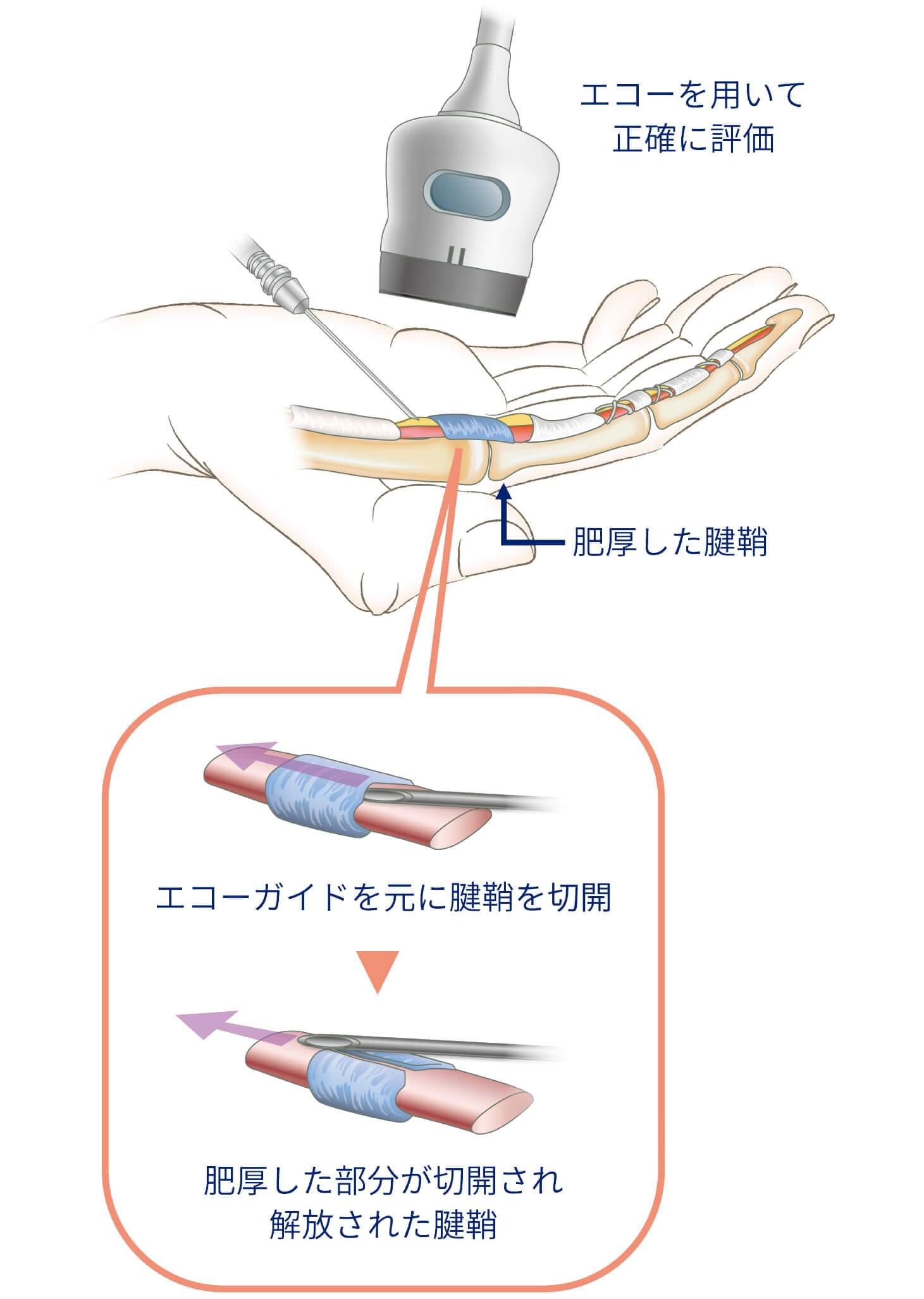 エコーガイド下経皮的腱腱鞘切開術イメージ